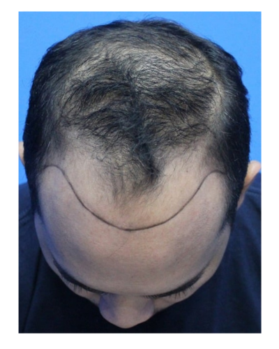 ARC Hair Transplant - Patient Before image 8