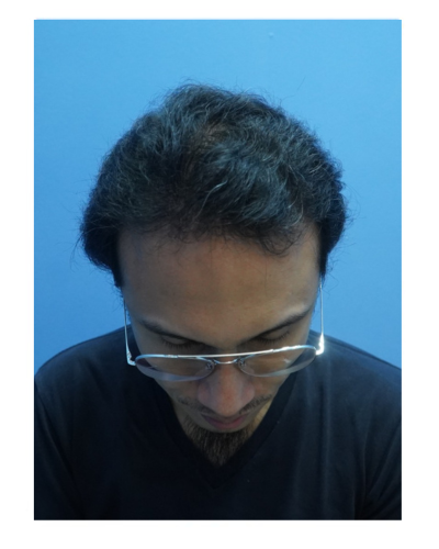 ARC Hair Transplant - Patient Before image 8