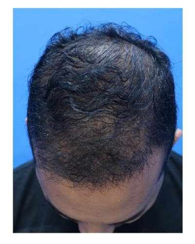 ARC Hair Transplant - Patient After image 9