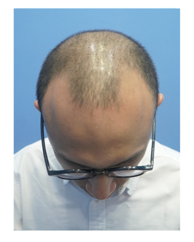 ARC Hair Transplant - Patient After image 8