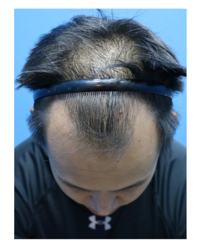 ARC Hair Transplant - Patient Before image 7