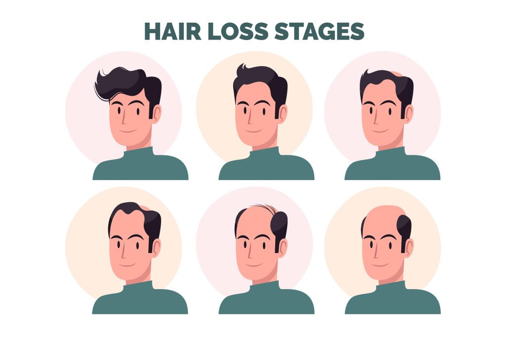 ARC Hair Transplant - Hair Loss Stage