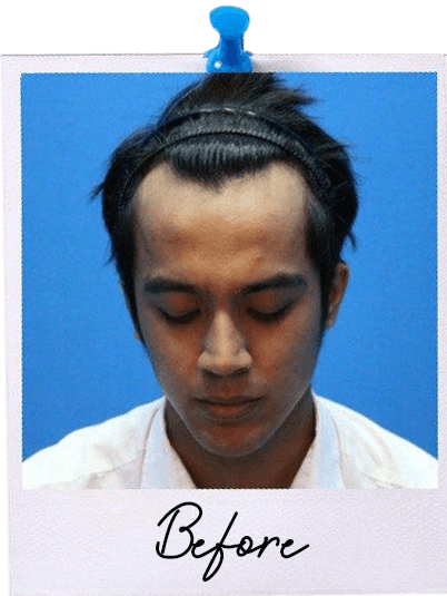 ARC Hair Transplant - Patient Before image 3