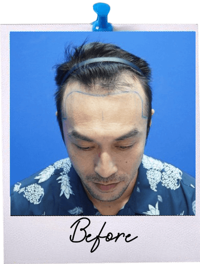 ARC Hair Transplant - Patient Before image 2