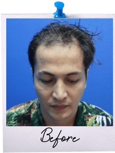 ARC Hair Transplant - Patient Before image 4