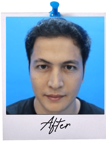 ARC Hair Transplant - Patient After image 1