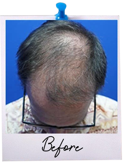 ARC Hair Transplant - Patient Before image 6