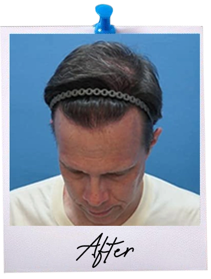 ARC Hair Transplant - Patient After image 6