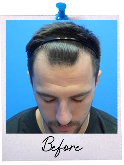 ARC Hair Transplant - Patient Before image 5