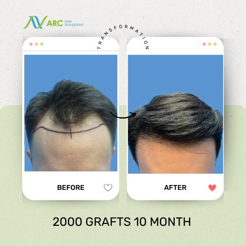 ARC Hair Transplant - Before After