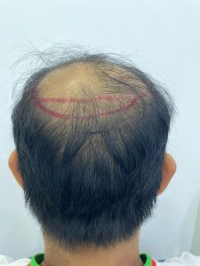 Hair loss treatment
