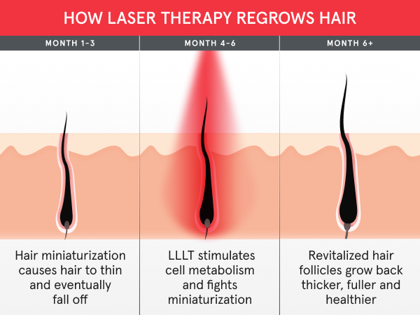 Laser therapy ARC