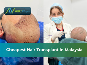 Cheapest Hair Transplant in Malaysia