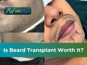 Is Beard Transplant Worth It