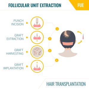 FUE Hair Transplant ARC