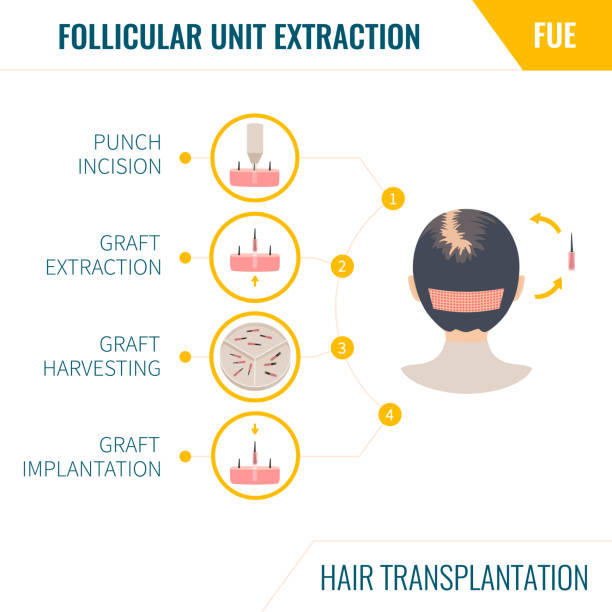 FUE Hair Transplant ARC