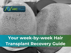 Your week-by-week Hair Transplant Recovery Guide