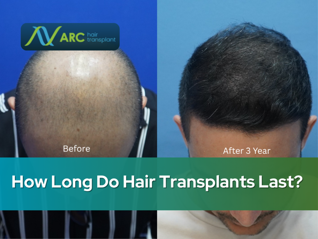 How Long Do Hair Transplants Last (1)