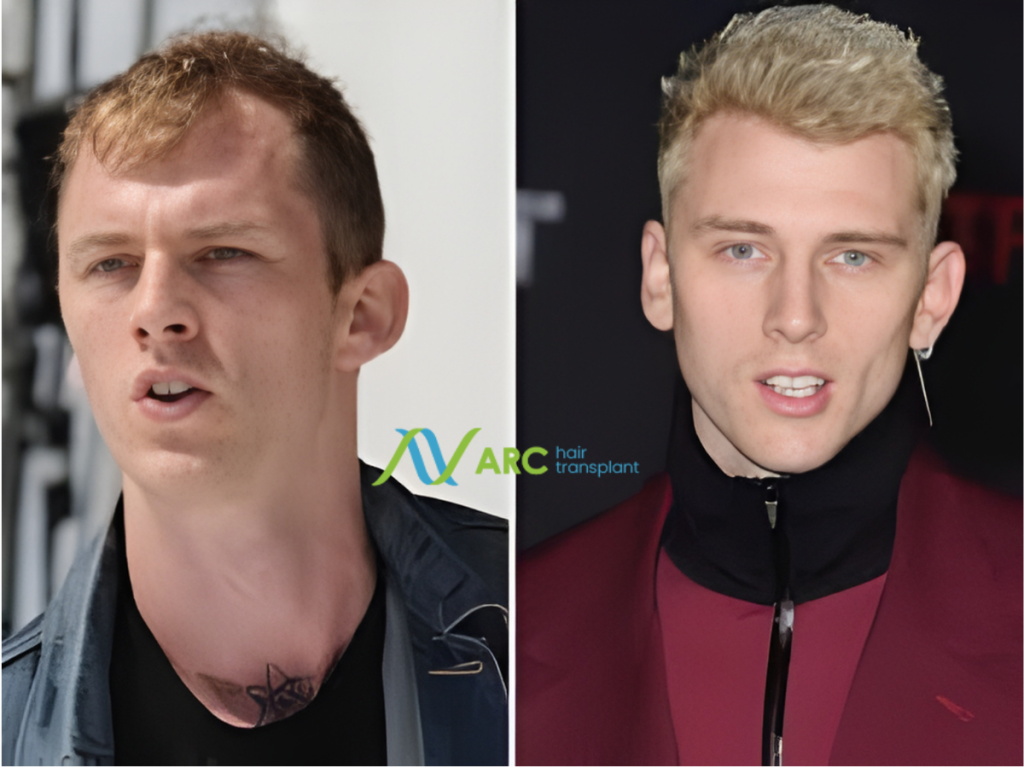 How Long Do Hair Transplants Last (5)