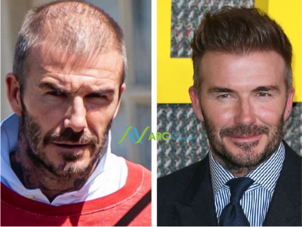 How Long Do Hair Transplants Last (6)