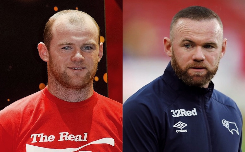 Wayne-Rooney-Hair-Transplant-London
